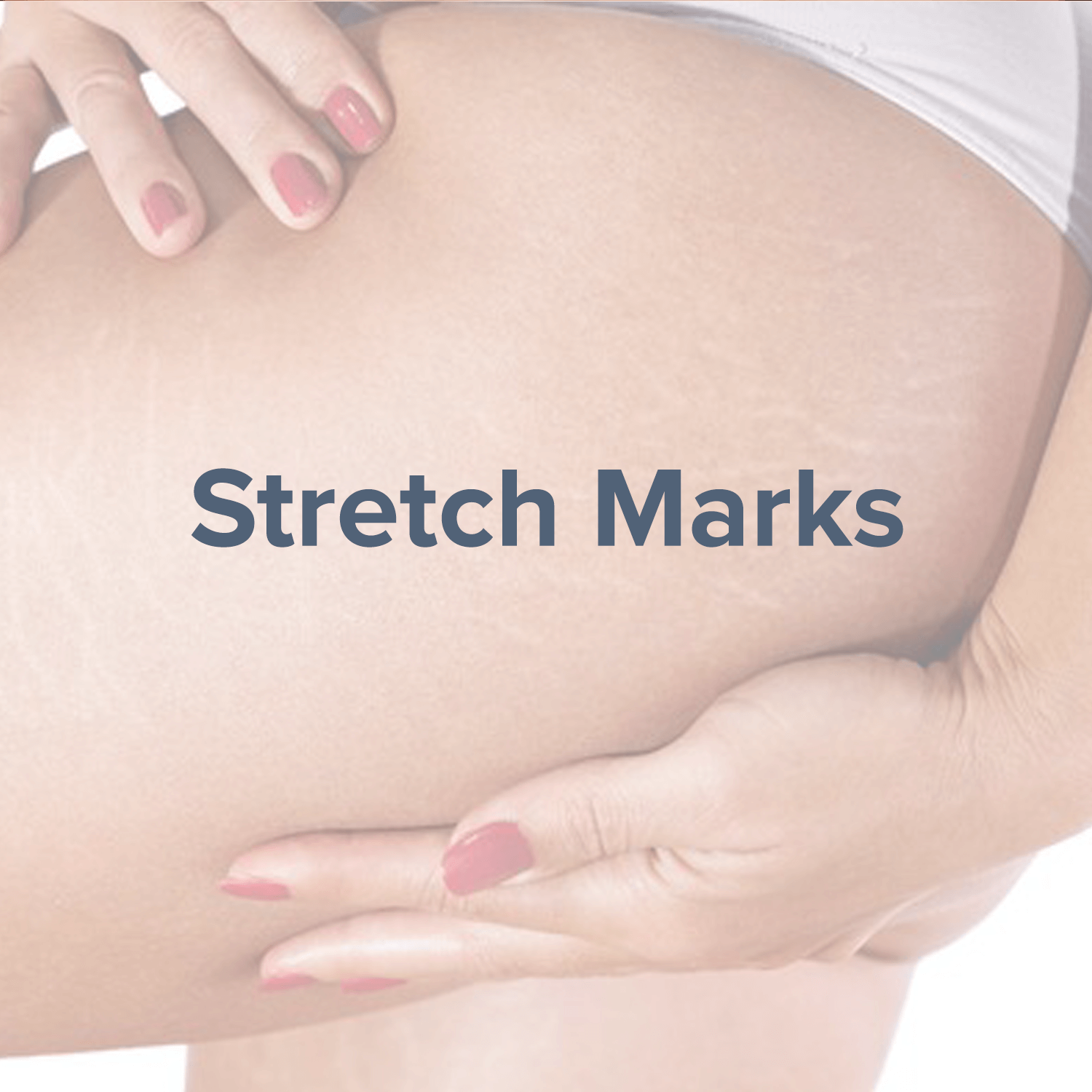 stretch-marks-removal.png