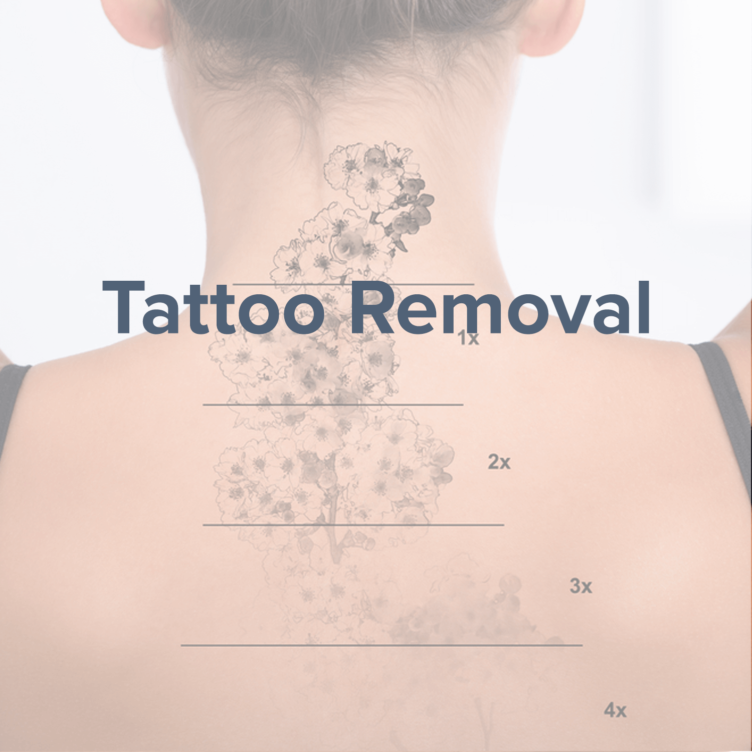 tattoo-removal.png