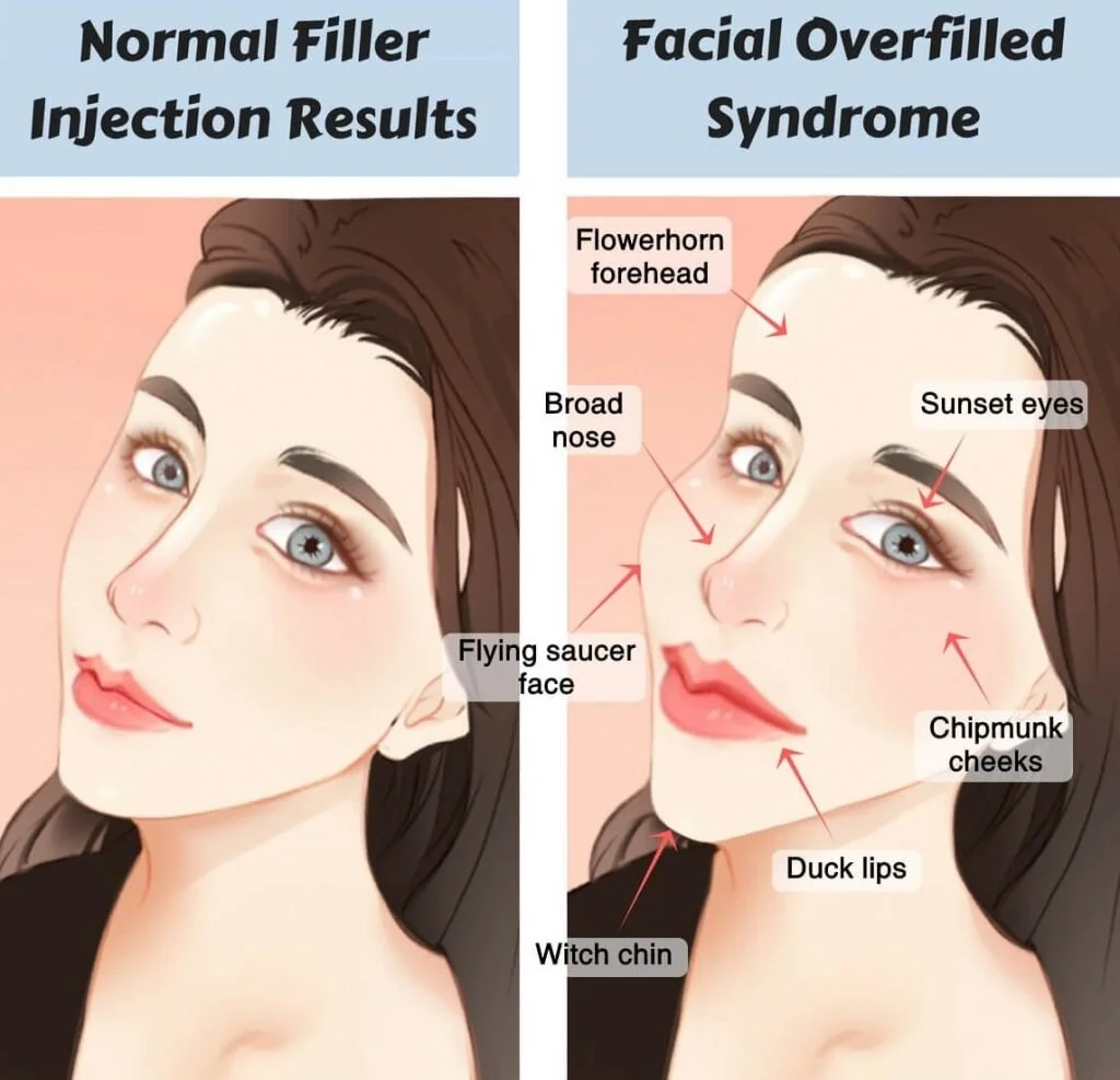 Fillers Gone Wrong: How to Avoid and How to Correct it?
