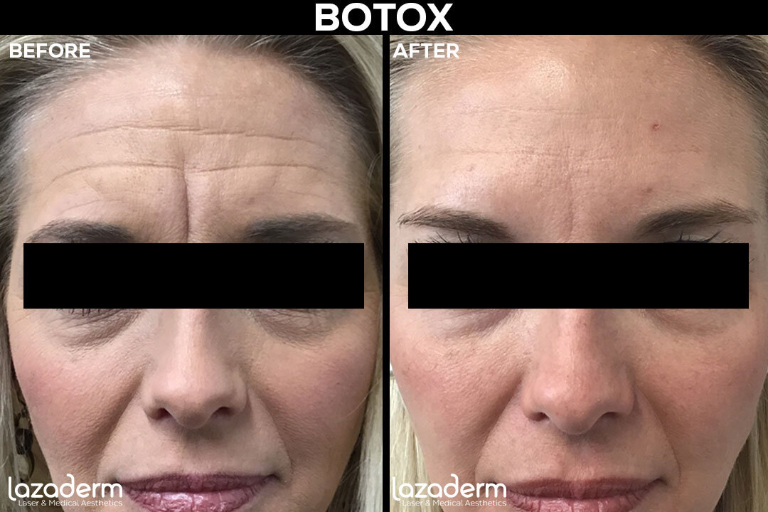 Before-and-After_web_template_botox.jpg