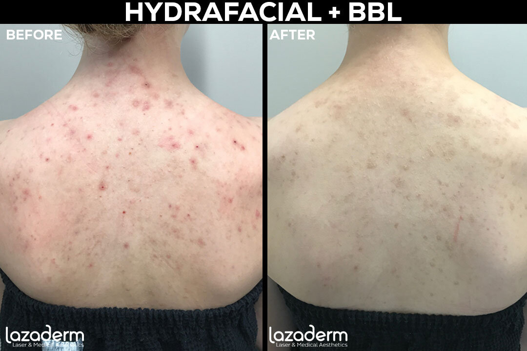 Before-and-After_web_template_hydrafacial+bbl.jpg