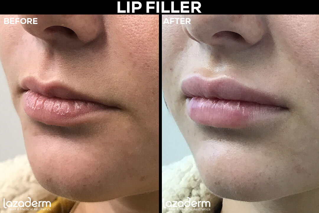 Before-and-After_web_template_lip-filler.jpg