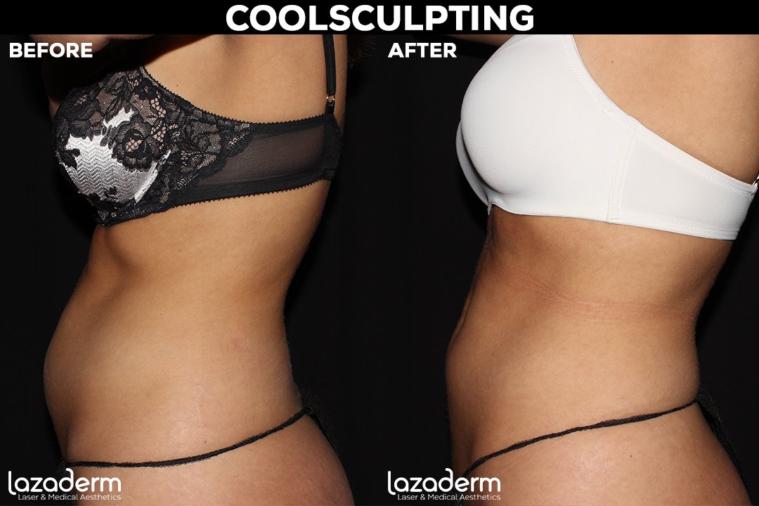 Body Contouring Near Me  Remove Chin Fat, Double Chin — Lazaderm Laser &  Aesthetics