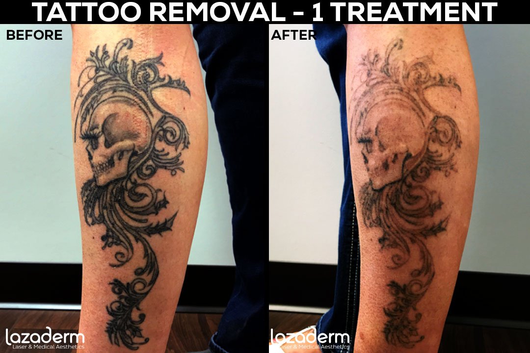 Laser Tattoo Removal How long until you can see results  LaserTat