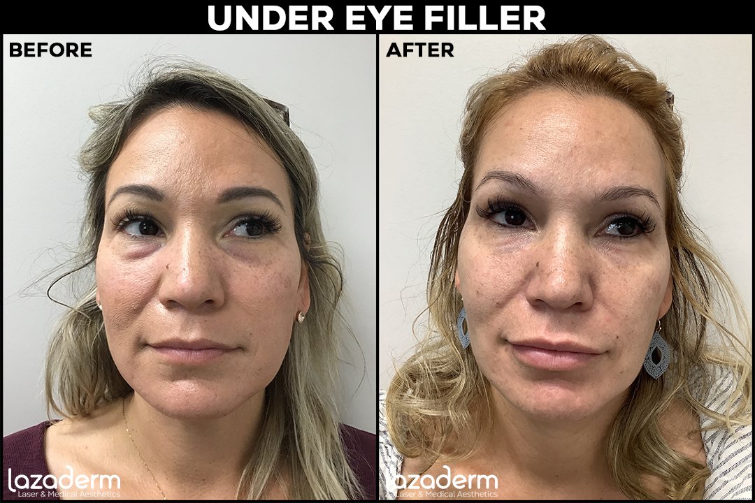 Before and After_web_under eye filler.jpg