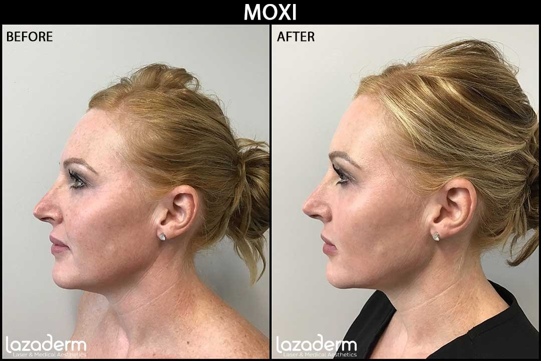 Before-and-After_Moxi-jenny.jpg