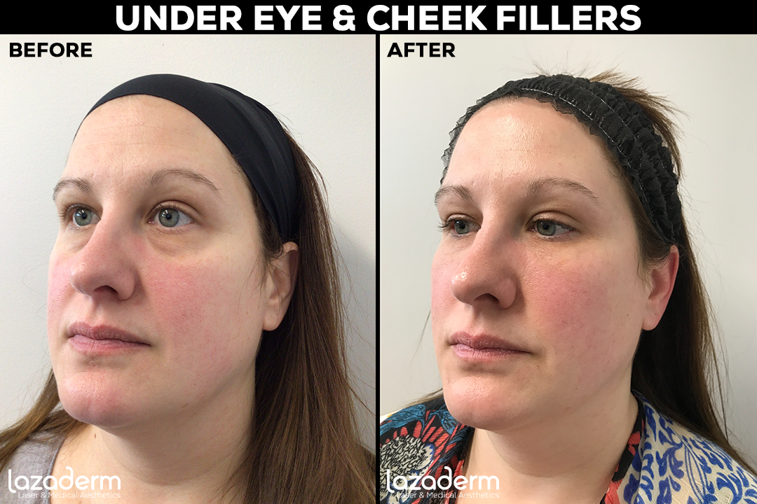 Before and After_UNDER EYE CHEEK.png