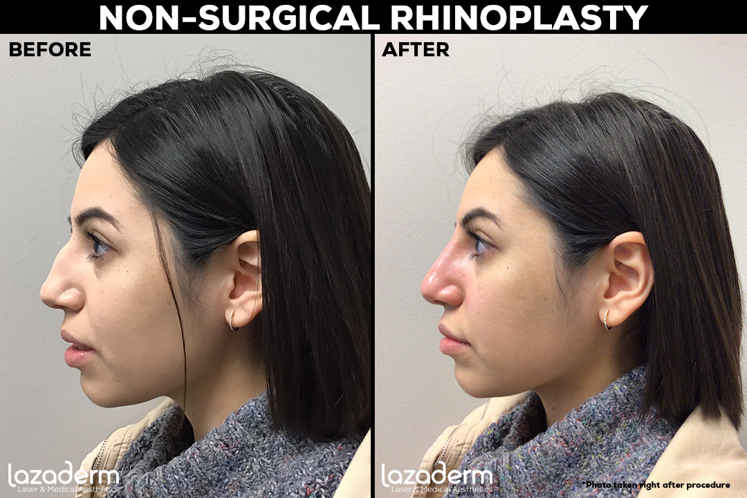 Before and After_non-surgical rhinoplasty.png