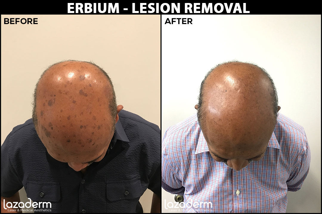 Before-After_Erbium-Lesion-Removla-head.png
