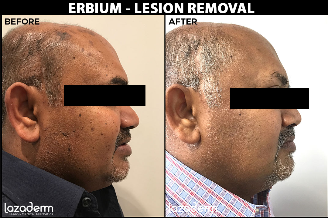 Before-After_Erbium-Lesion-removal-side.png