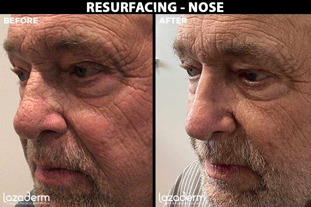 Before-and-After_Resurfacing-nose.jpg