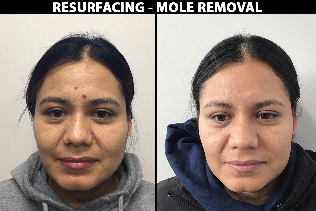 Before-After_Resurfacing-Mole-Removal.png