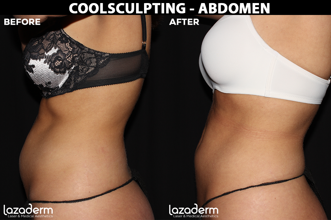 Before-After-CoolSculpting-Abdomen.png