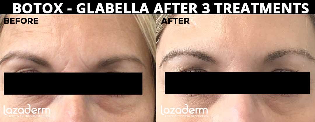 Before-After_Botox-Glabella3tx.jpg