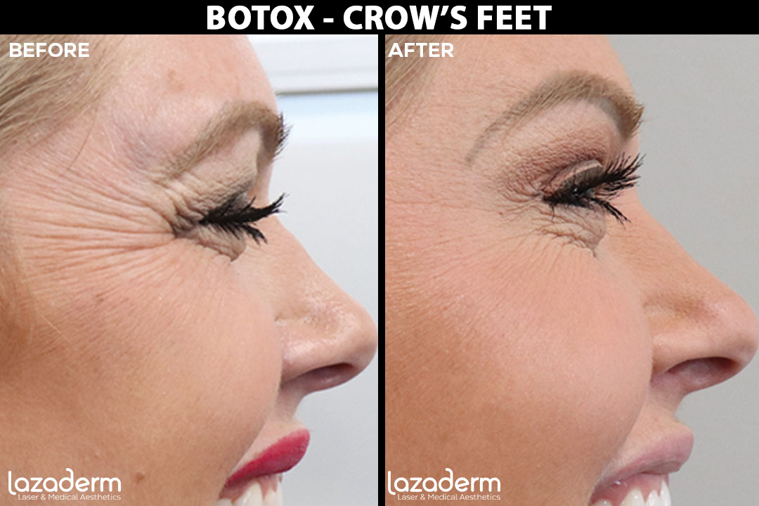 Before-After_Botox-Crows-Feet.png