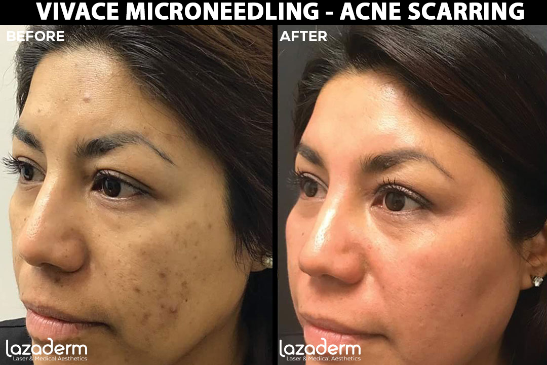 Before-After_VMicroneedling-Acne-Scaring-Liz.png