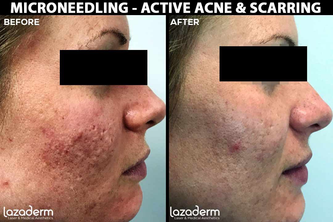 Before-After-Microneedling-acne-scarring.jpg