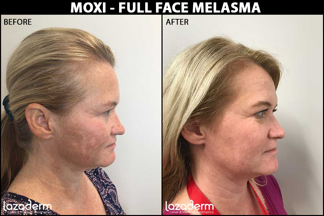Before-After_Moxi-Melasma.png