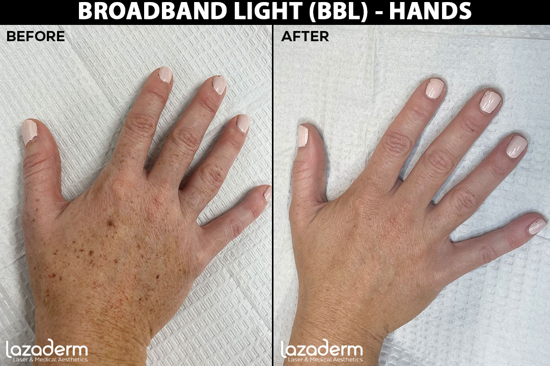 Before-After_BBL-Hands.png