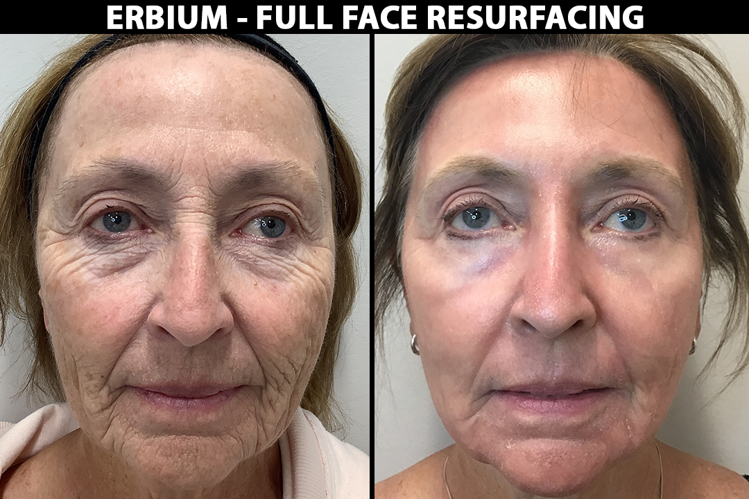 Before-after_Erbium-resurfacing-pat.png