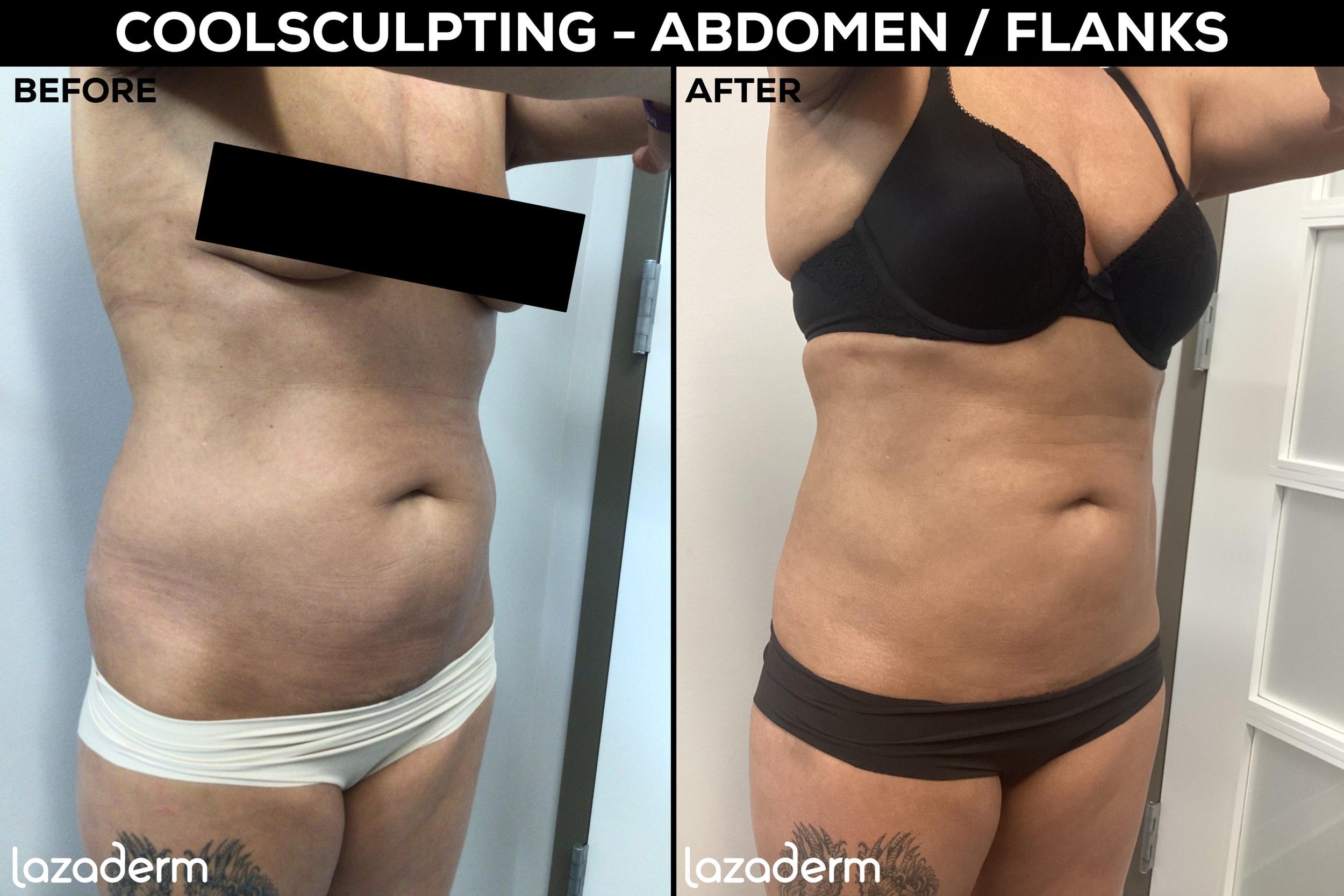 Before-and-After-CoolSculpting-AbFlanks-scaled.jpeg