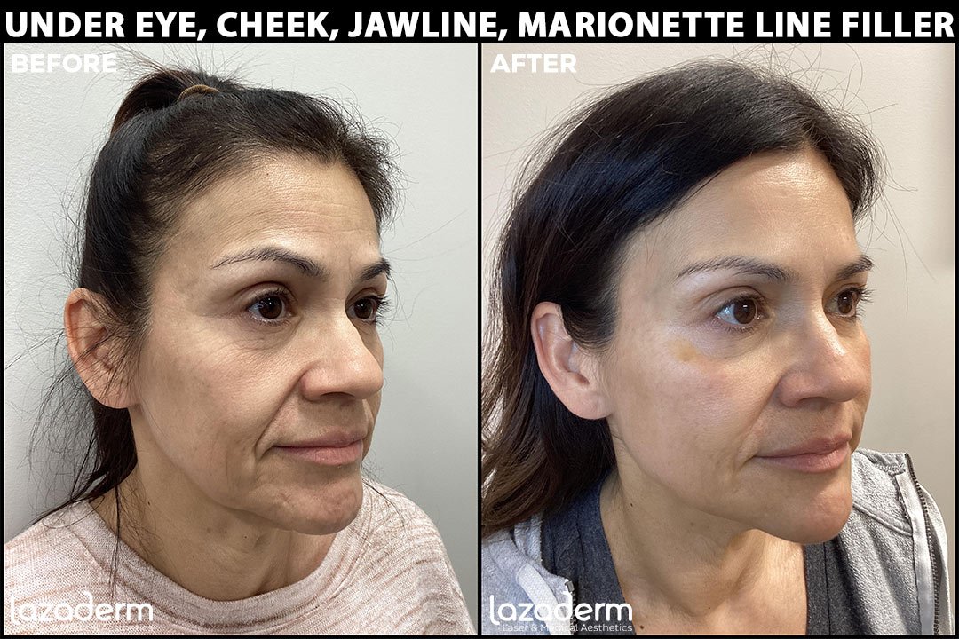 under-eye-cheek-jaw-smilelines-Filler_Before-and-After.jpg