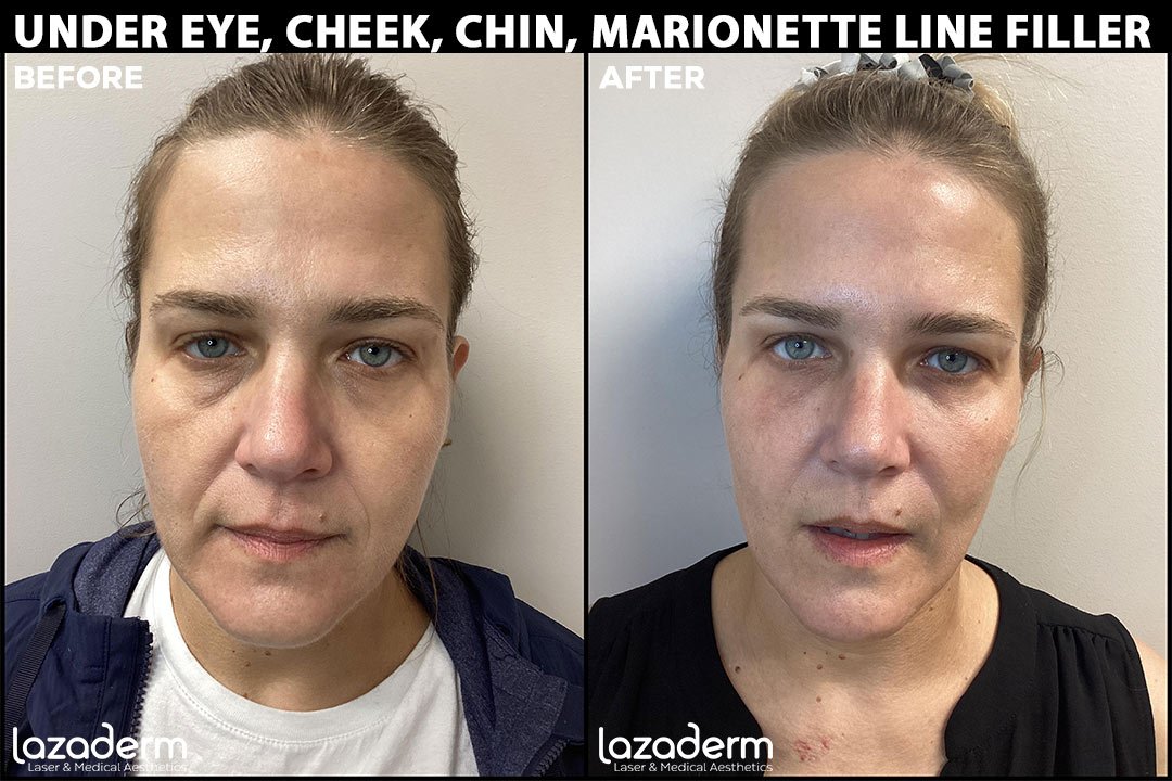 Before-and-After_under-eye-filler.jpg