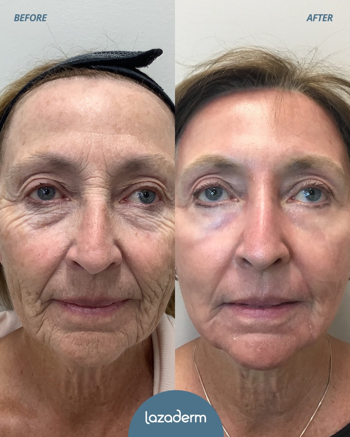Skin, refined.
Full-face erbium laser resurfacing for smoother texture, brighter tone, and timeless results.

✨ Ready to elevate your skin?
Book your consultation today.

#Lazaderm #ErbiumLaser #LaserResurfacing #BeforeAfterSkin #medspa