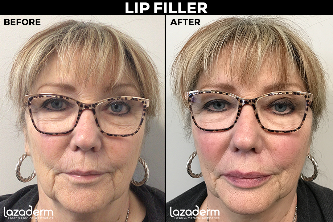 Before and After_lip filler 2.png