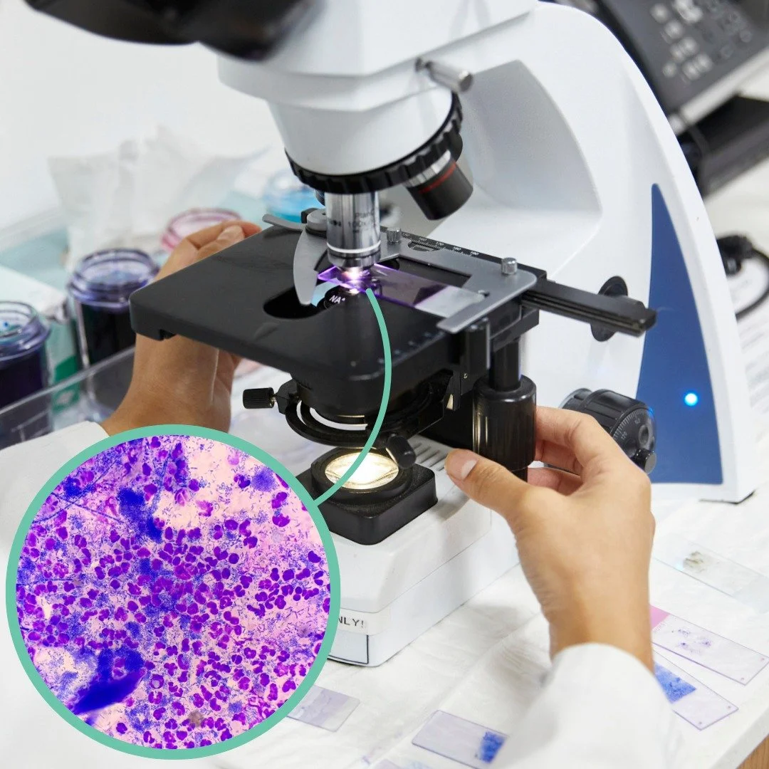 Things We See Under the Microscope 🔬

Mixed infection: cocci, rods &amp; neutrophils 🦠

Sometimes, it&rsquo;s not just one type of organism causing trouble. In this sample, we can see both cocci (round bacteria) and rods (rod-shaped bacteria), alon