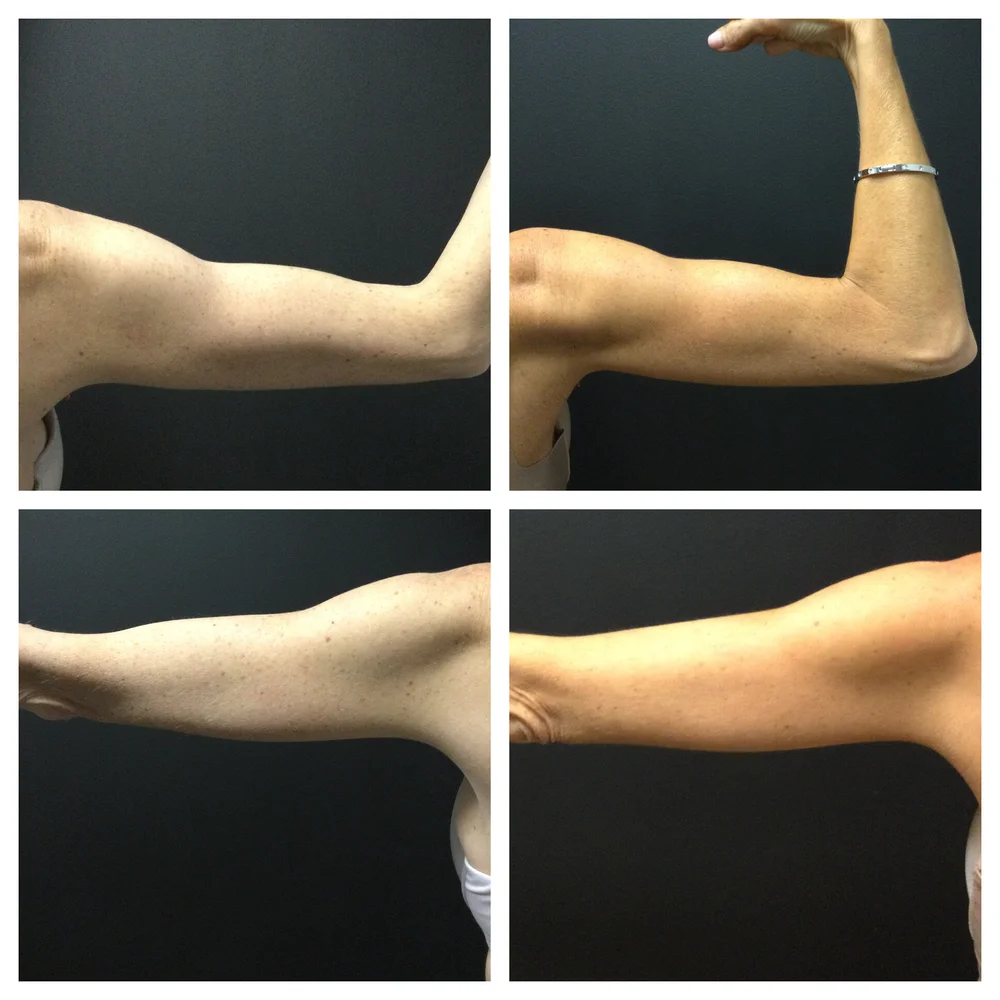 EMSculpt — Rockland Med Spa