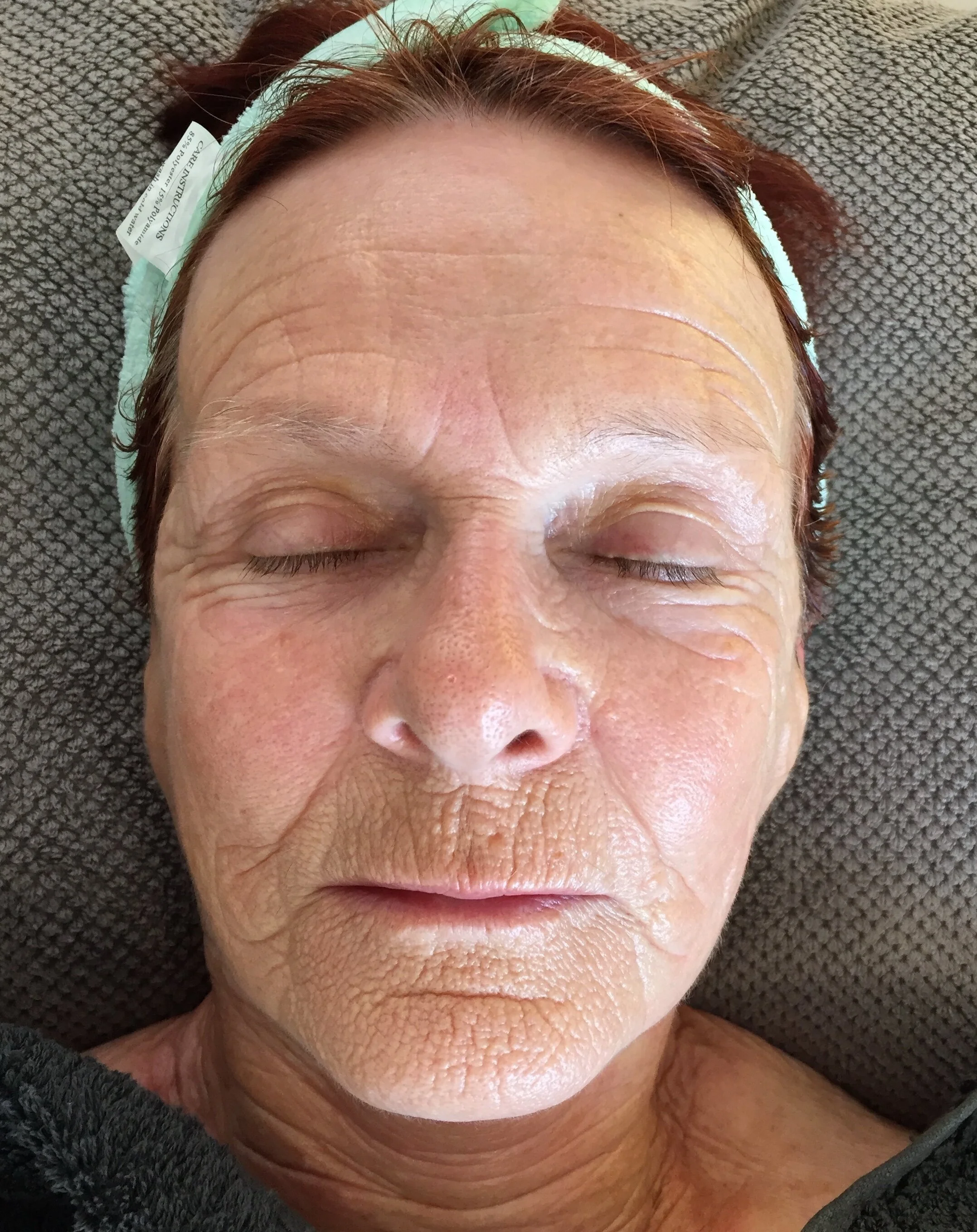 10th+Nov+after+treatment.jpg