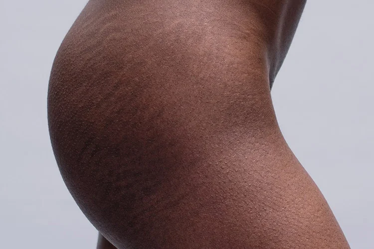 Stretch Mark Reduction.jpg