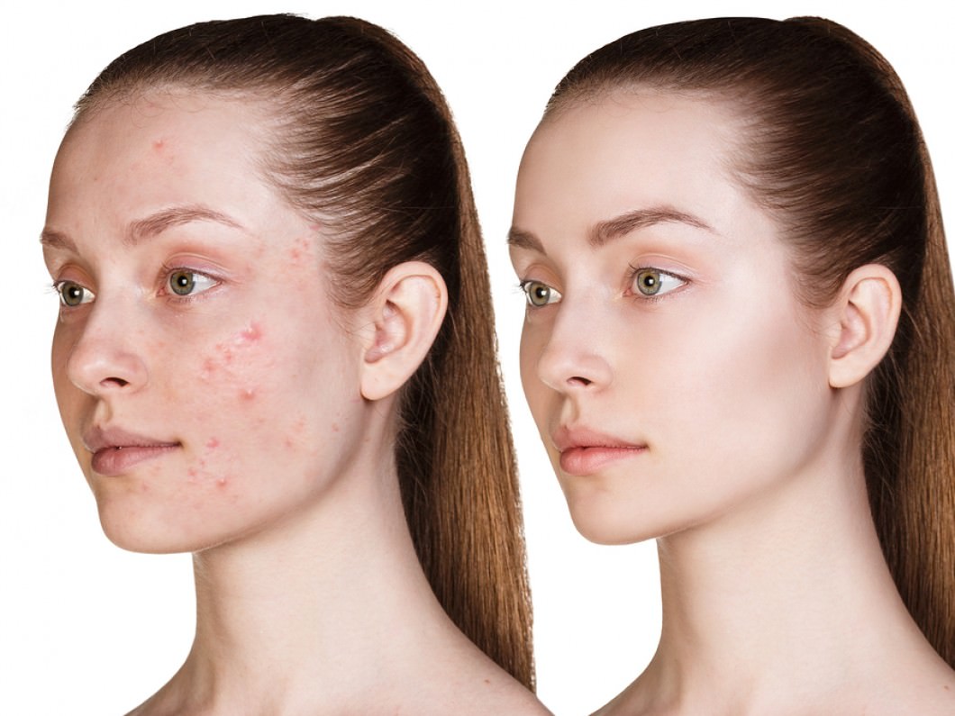 Beauty Talks - Kingsland - Auckland - Acne Treatment 1.jpg