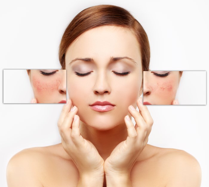 Beauty Talks - Kingsland - Auckland - Acne Treatment 3.jpg