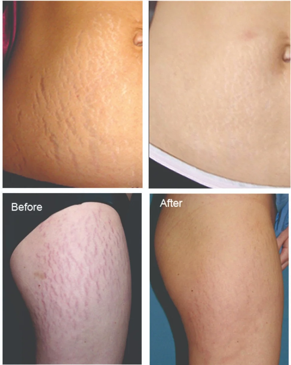 Beauty+Talks+-+Kingsland+-+Auckland+-+Stretch+Mark+Reduction+6.jpg
