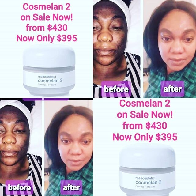 Cosmelan 2 on Sale now! 
DM to order or order online at www.beautytalks.co.nz ☎️ 021-679-789
Available for pick-up and delivery 
#mesoestetic #skincare #cosmelan
#beautytalksnz #beautifulyou