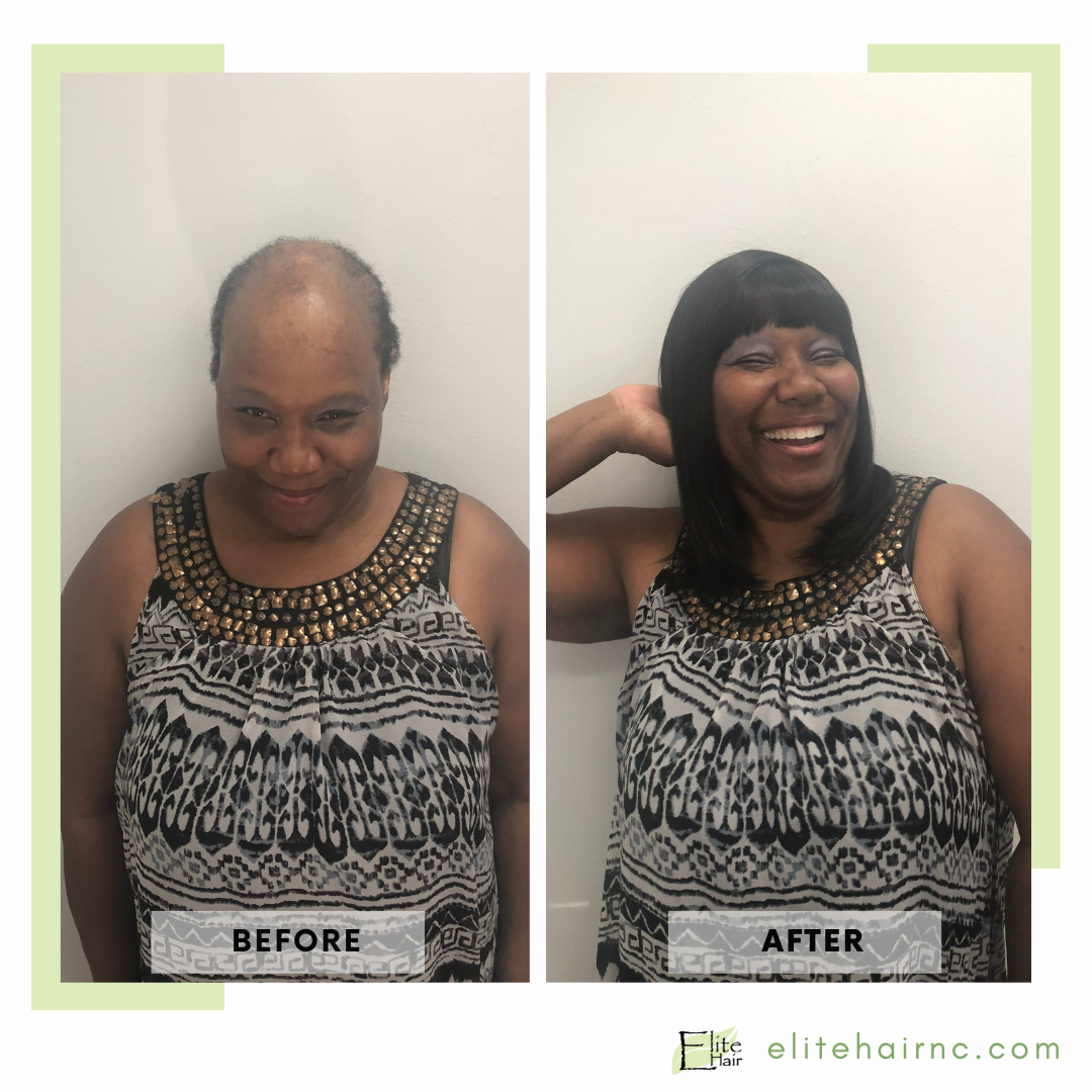 Elite Hair Replacement Center