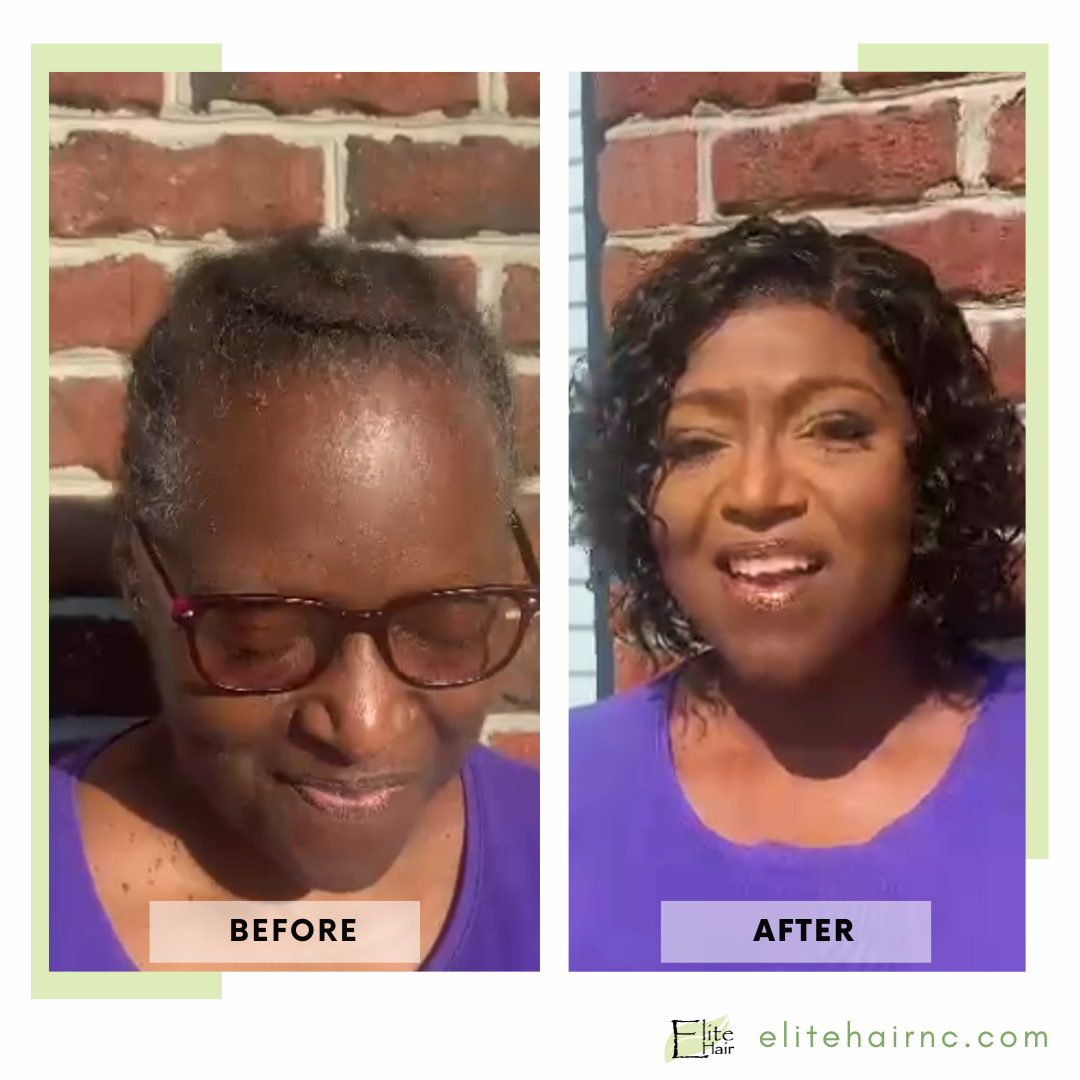 Elite Hair Replacement Center