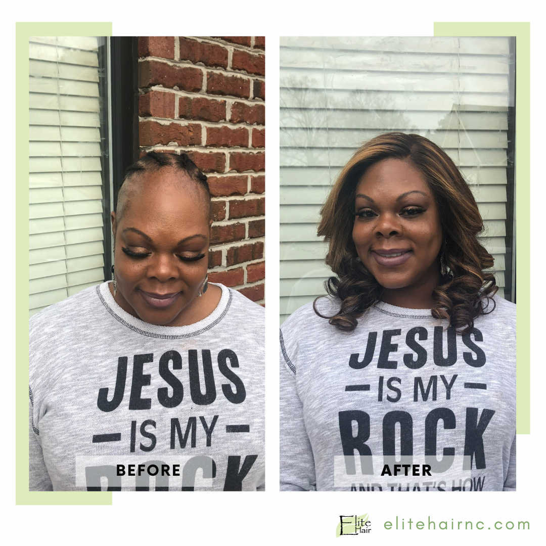 Elite Hair Replacement Center