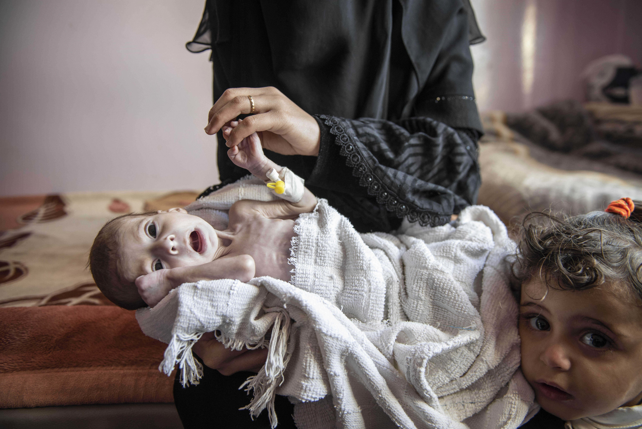  Four month old Oday is one of many severely malnourished infants also struggling against infections at the Sabeen hospital in Sana'a. Yemen.
Photo by Jack Hill, 18 November 2018
 