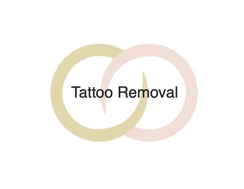 tattoo removal.jpg