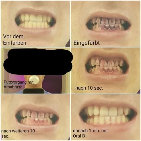 Vor dem Einfärben = Before using the developer (a solution similar to the GUM red we used) Eingefärbt = After using the coloured solution to reveal plaque Putzvorgang mit Amabrush = Use of Amabrush Nach 10 sec = After 10 seconds (of "brushing") Nach weiteren 10 sec = After 10 additional seconds (i. e. 20 seconds of brushing) Danach 1 min. mit Oral B = After 1 minute with a classic - toothbrush - Oral B Photo Credit: zvg