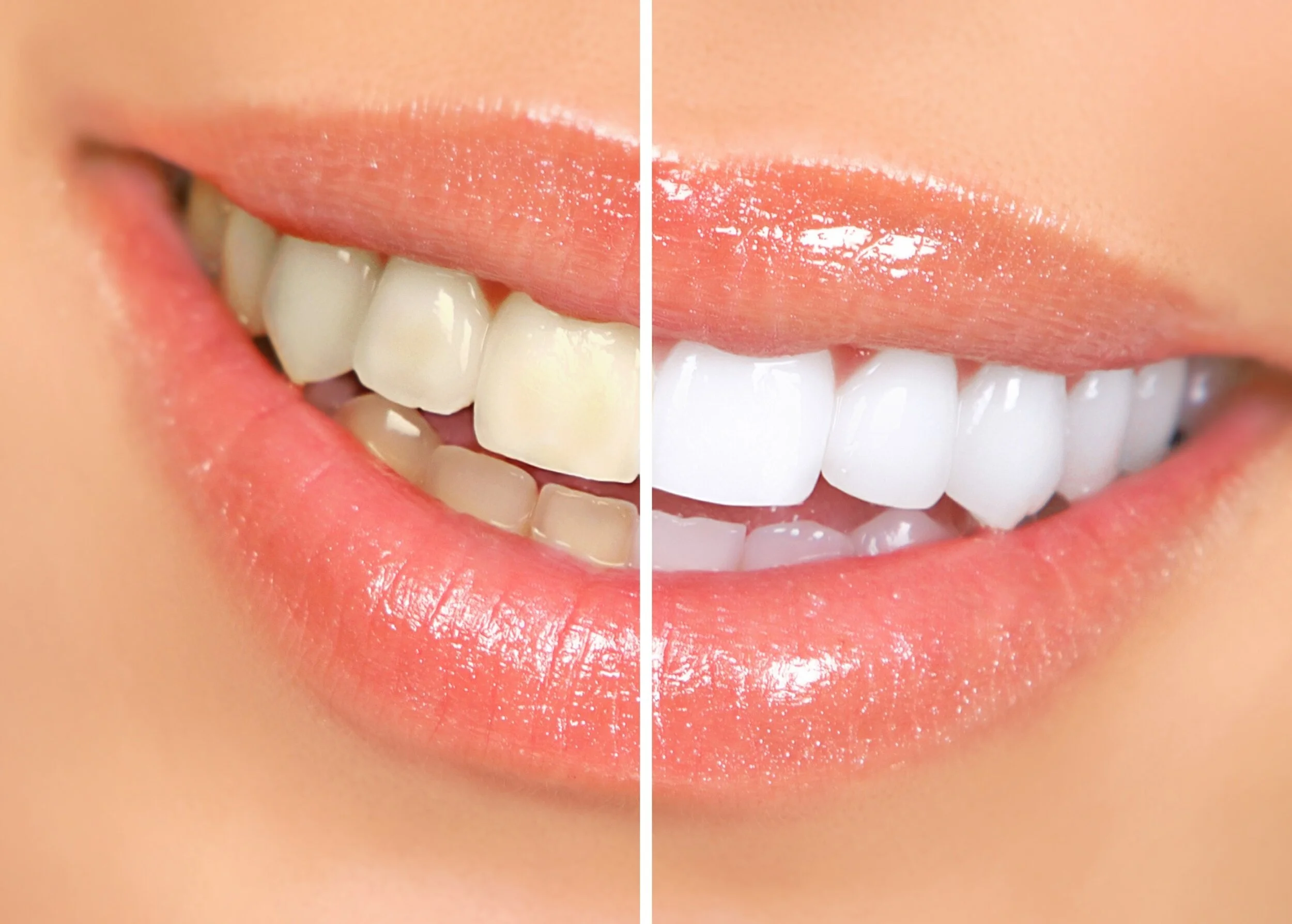 Tips for Keeping Your Teeth White