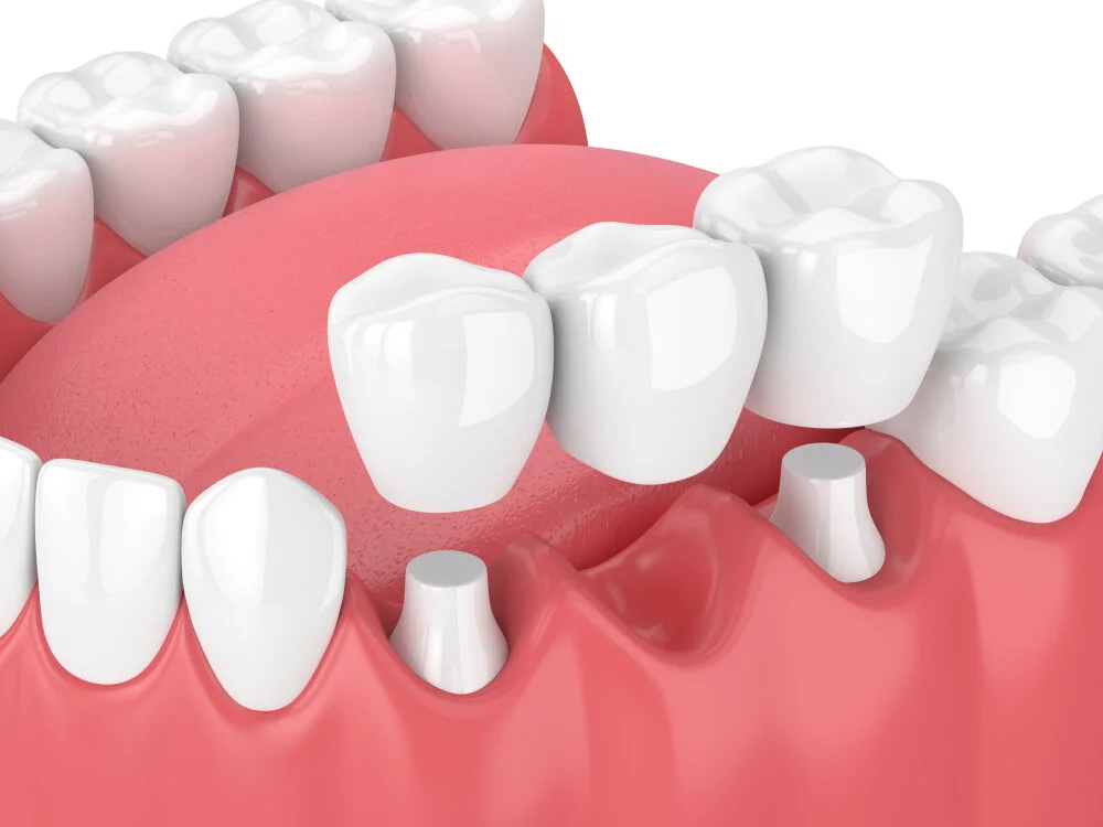 Dental Implants vs. Bridges