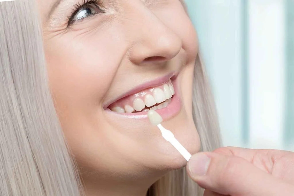 The Advantages of Dental Veneers