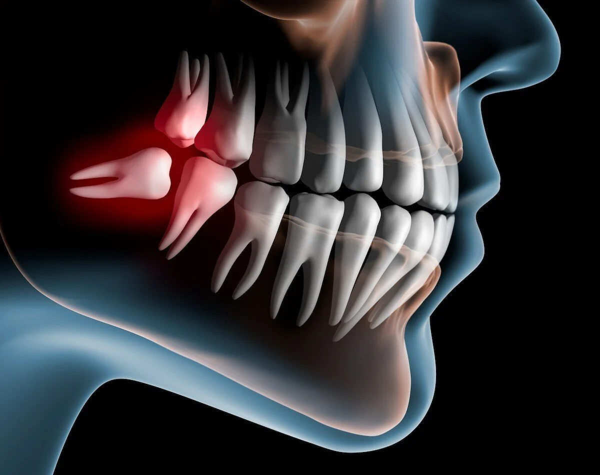 Benefits of Removing Wisdom Teeth