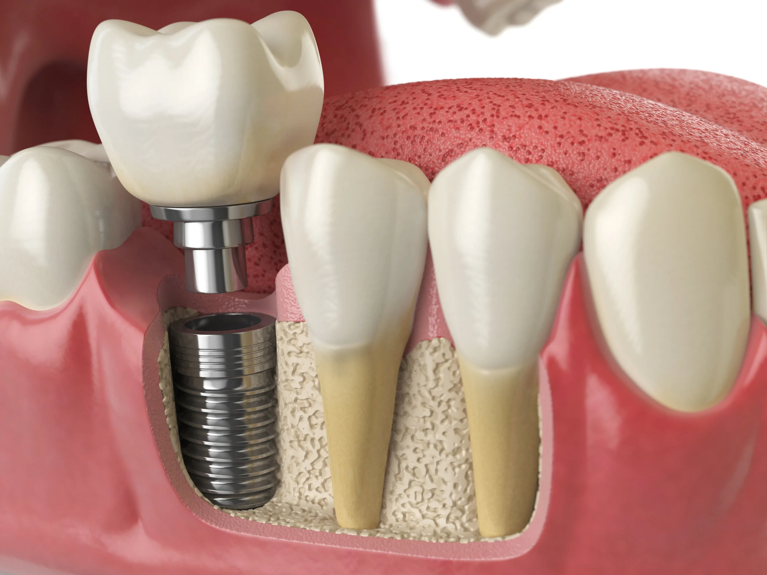 Are Dental Implants an Option With Severe Bone Loss? 