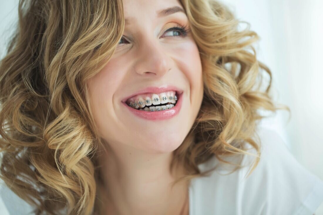Do I need braces?