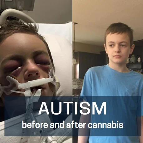 Episode 118: Cannabis Nothing Short of Miracle For Boy With Severe Autism And Seizure Disorder